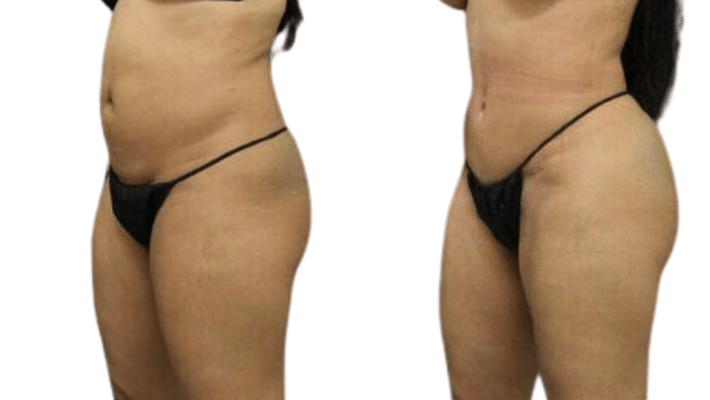 BBL before and after case 3 oblique view