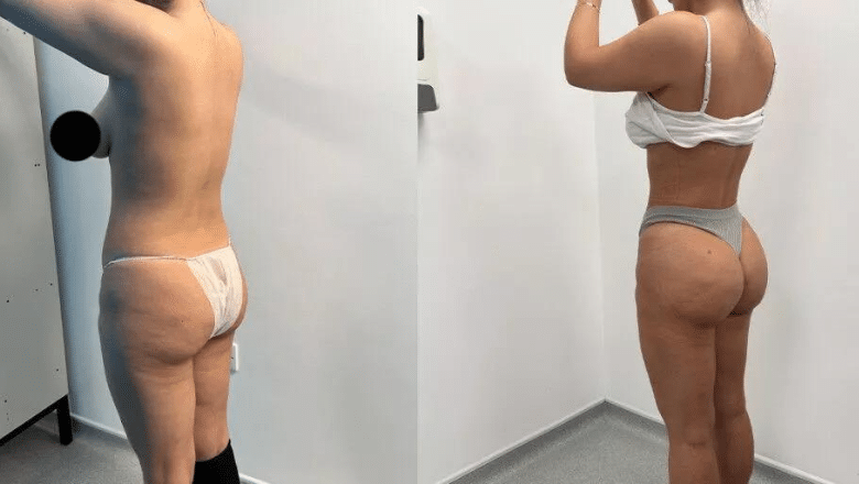 360 lipo and BBL before and after case 17 view 2