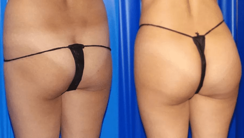 BBL before and after case 10 side view