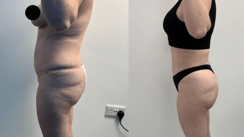 360 lipo and BBL before and after case 15 view 3