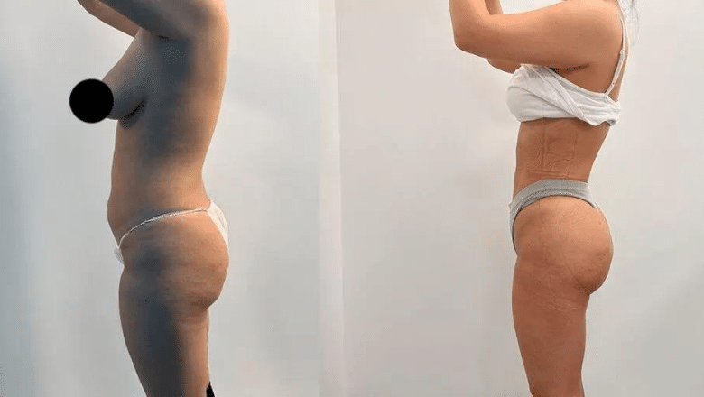 360 lipo and BBL before and after case 17 view 3