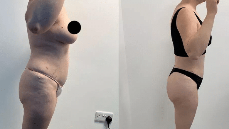 360 lipo and BBL before and after case 15 view 4