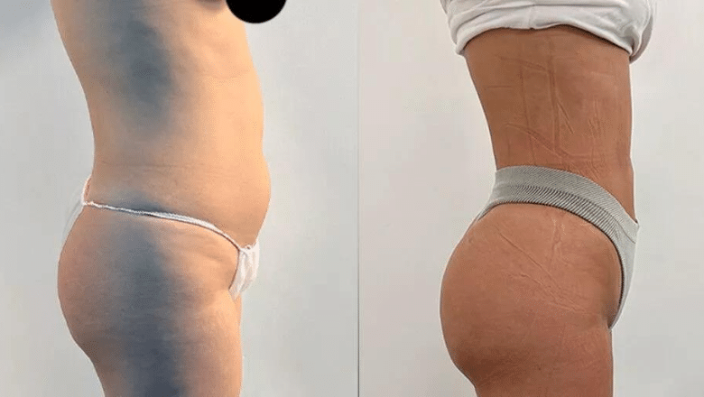 360 lipo and BBL before and after case 17 view 4