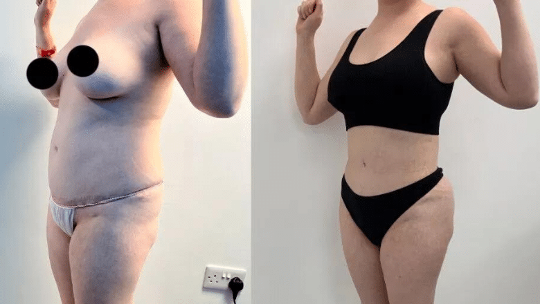 360 lipo and BBL before and after case 15 view 5