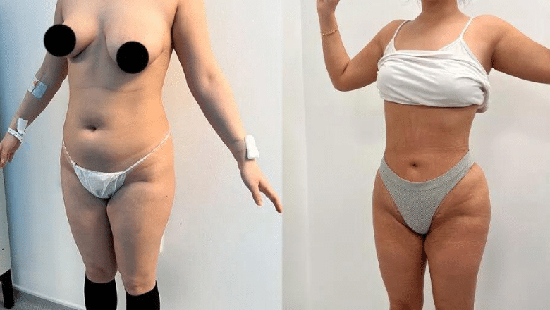 360 lipo and BBL before and after case 17 view 5