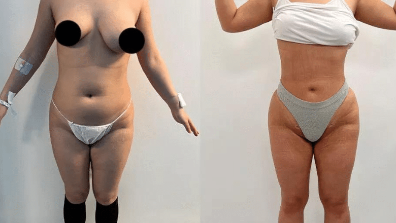360 lipo and BBL before and after case 17 view 6