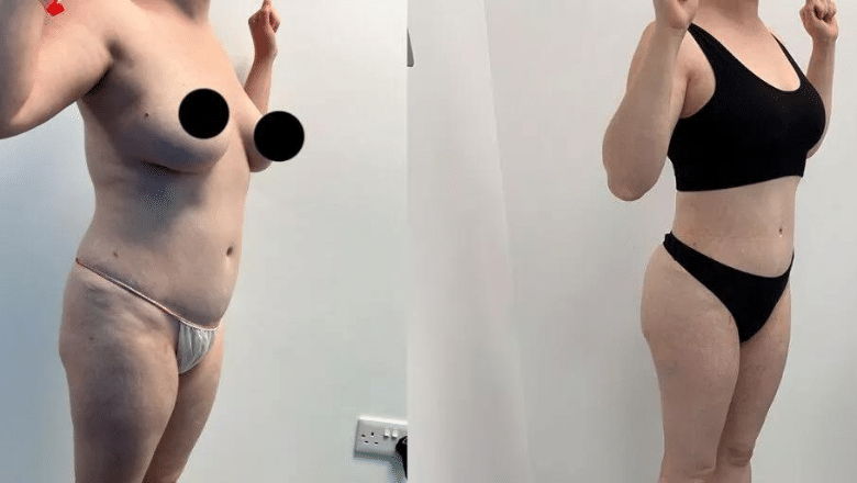360 lipo and BBL before and after case 15 view 6