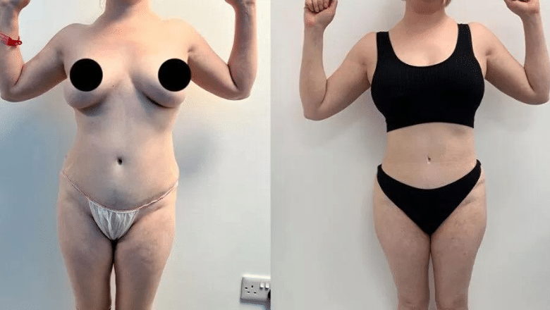 360 lipo and BBL before and after case 15 view 7