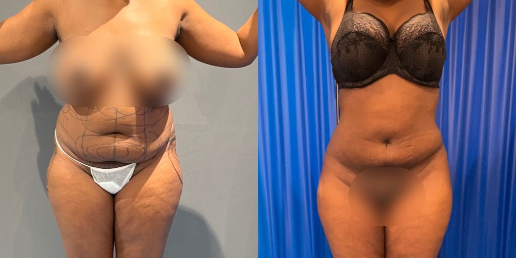 BBL before and after case 9 view 2