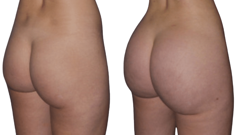 BBL before and after case 2 side view