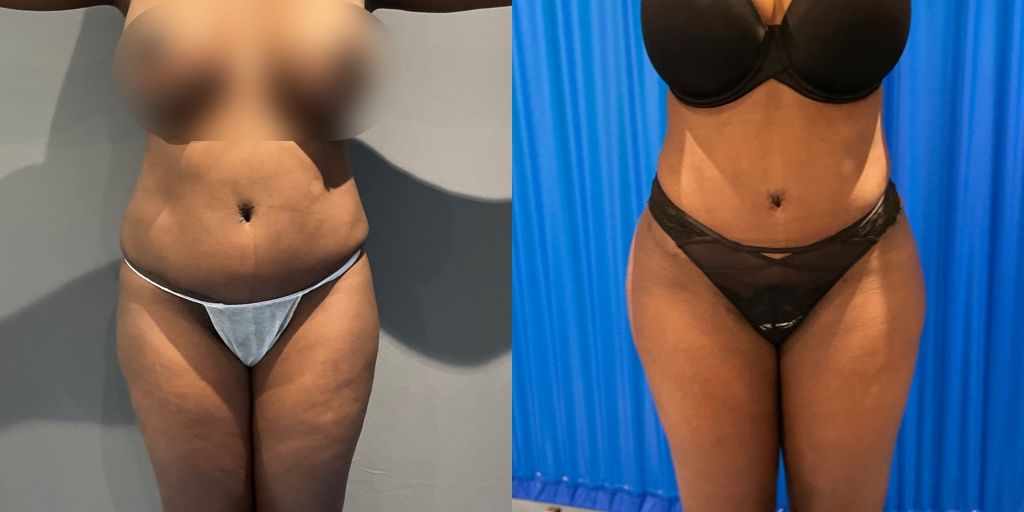 BBL before and after case 6 alternate front view
