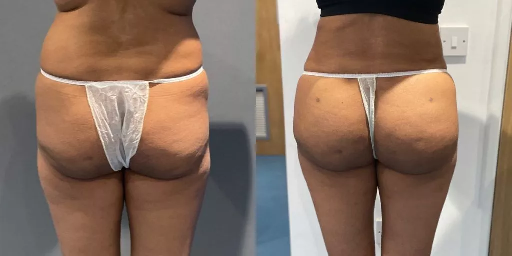 BBL London before and after case 13