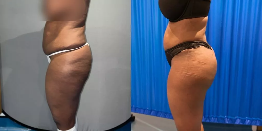 BBL before and after case 6 side view