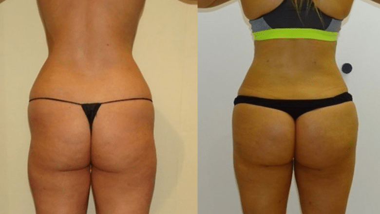 BBL before and after case 21