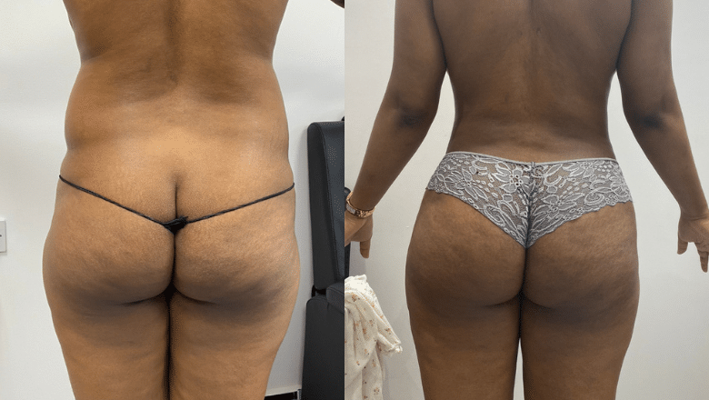 Brazilian butt lift before and after case 22