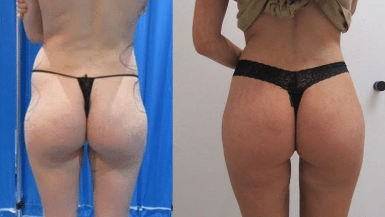 skinny BBL before and after London