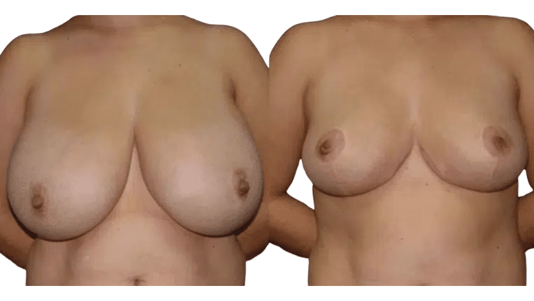 breast reduction before after