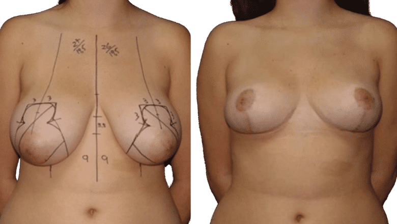 Breast Reduction Results London
