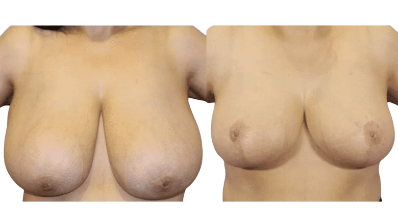 Breast Reduction UK Results