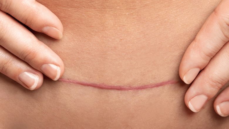 Do hypertrophic scars go away — treatment guide at Centre for Surgery London
