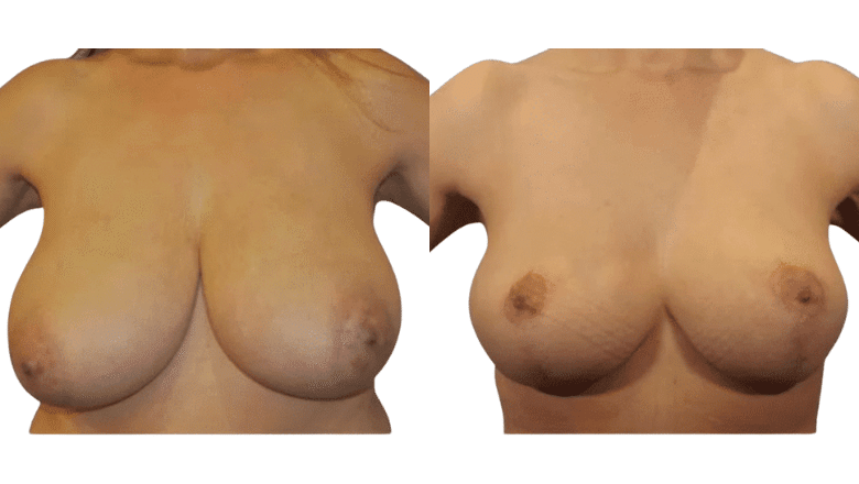 Breast-Reduction-UK-Results