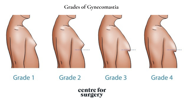 Different Grades of Gynecomastia