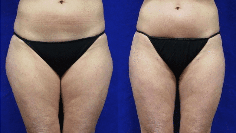 liposuction-thighs
