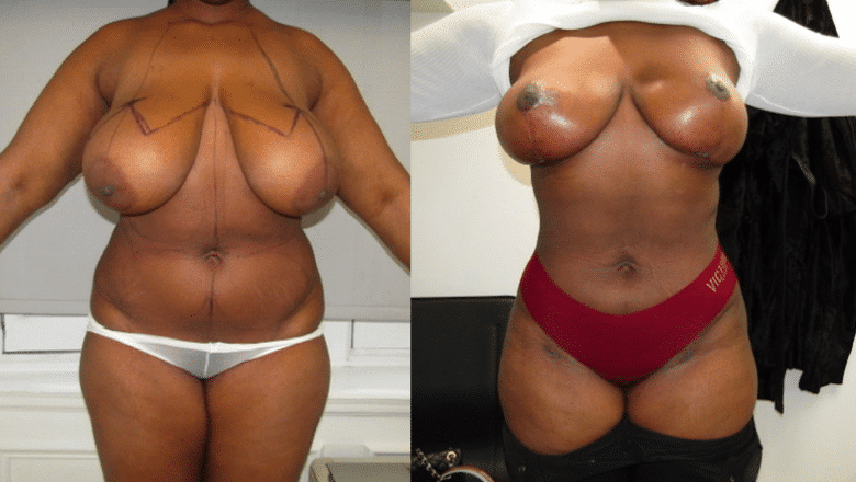 tummy tuck with breast reduction before after