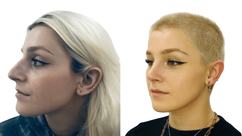 Rhinoplasty before and after photos