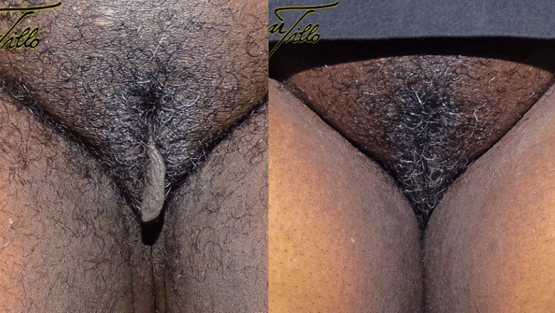 labia minora wedge excision results
