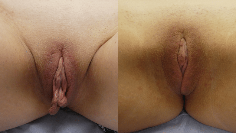 Labiaplasty result