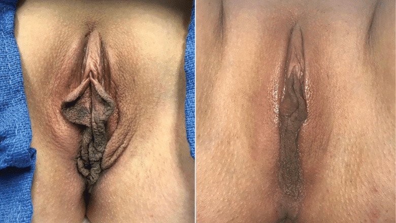 labiaplasty-before-after-10