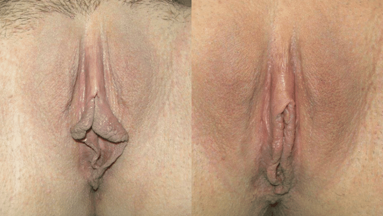 labiaplasty-before-after-2