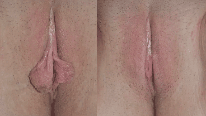labiaplasty-surgery-before-after-6