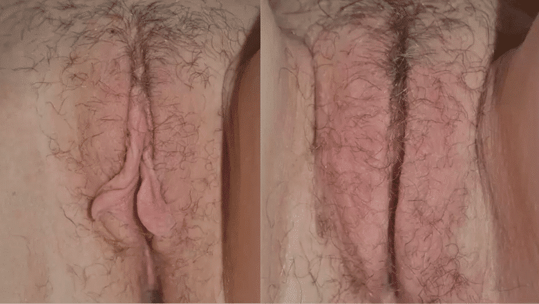 labiaplasty-surgery-before-after-8