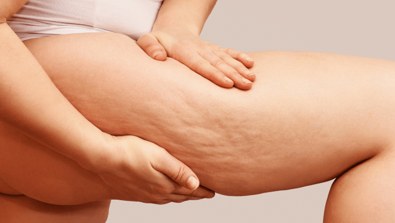 Can Liposuction Get Rid of Cellulite