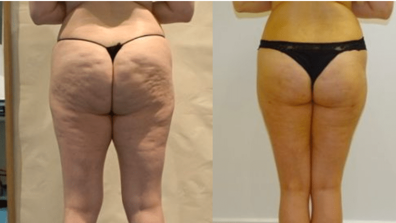 cellulite procedure results