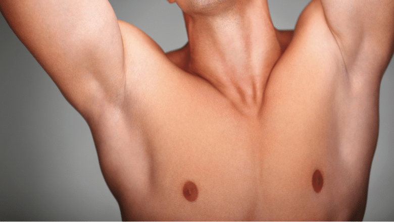 Non-Surgical Treatments for Gynecomastia