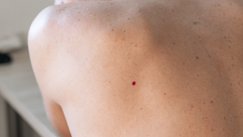 Can Laser Treatment Remove Cherry Angiomas Permanently