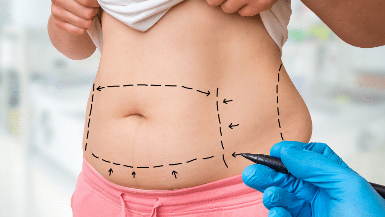 How Much Fat Can Be Removed During Liposuction