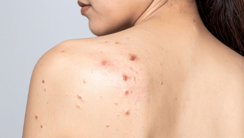 Is laser treatment more effective than medication for acne
