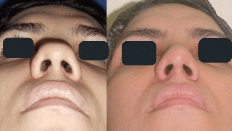 alar base reduction before and after