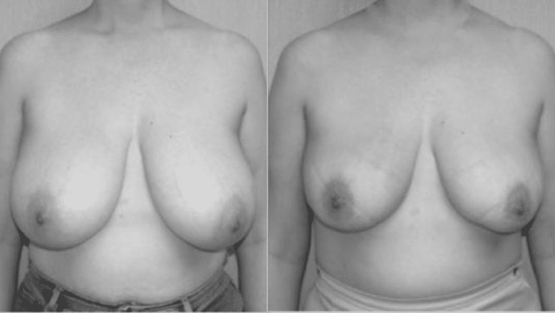 breast liposuction before after 4