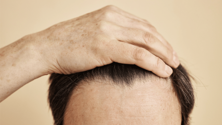Is Forehead Reduction Suitable for Patients with Receding Hairlines