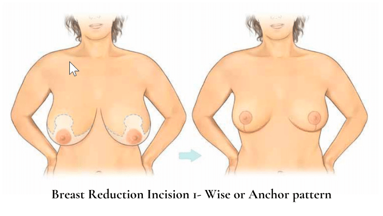 Breast reduction anchor incision Wise pattern diagram showing incision lines around areola vertically to breast crease and horizontally along inframammary fold — Centre for Surgery London