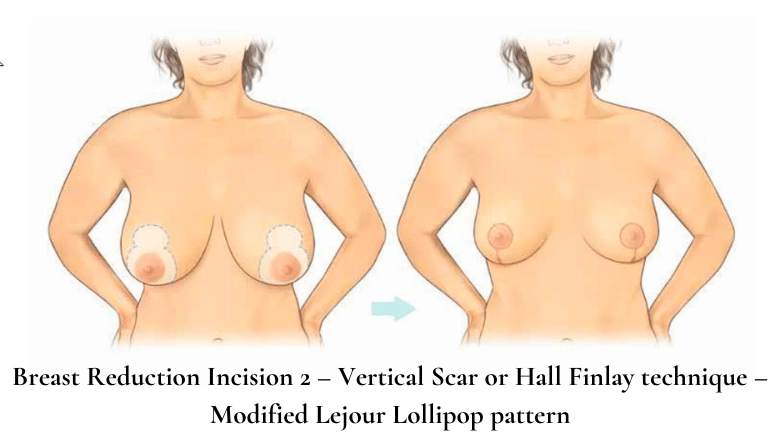 Breast reduction lollipop incision vertical scar Hall-Findlay technique diagram showing periareolar and vertical incision pattern — Centre for Surgery London