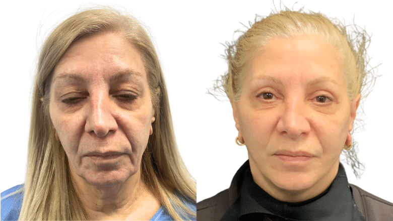 Facelift and neck lift result showing long-term natural rejuvenation at Centre for Surgery London