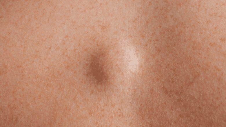 Lipoma removal recovery London — Centre for Surgery Baker Street