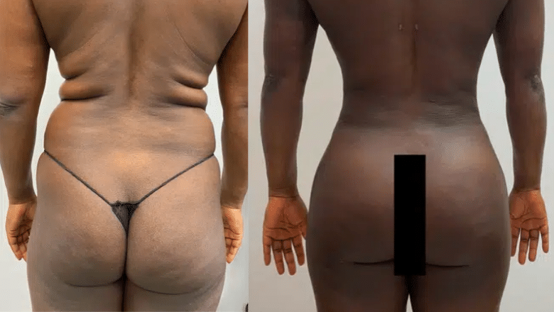 Brazilian butt lift before and after case 1 — natural rounded shape front view Centre for Surgery London