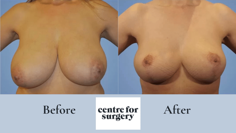 Breast reduction surgery before and after results at Centre for Surgery London showing natural proportionate outcome